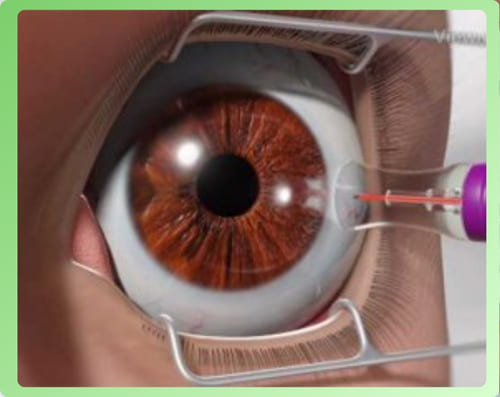 Điều trị cườm nước bằng laser
