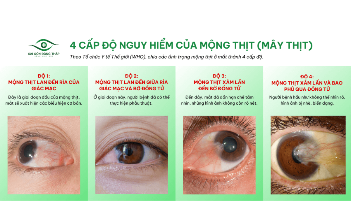 Hình ảnh trên là 4 cấp độ của mộng thịt