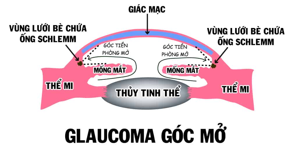 glaucoma-goc-mo
