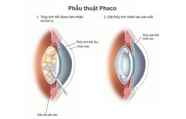 phau-thuat-phaco