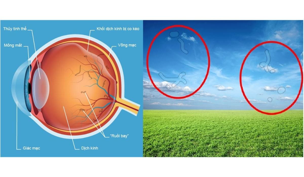 Cận cảnh đáy mắt với tổn thương thoái hóa võng mạc