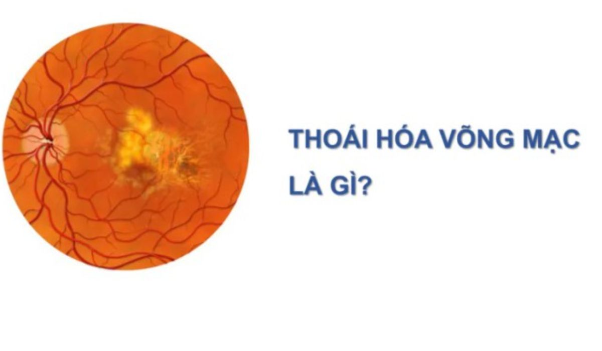 Võng mạc – lớp màng thần kinh mỏng ở đáy mắt, bị kéo và tổn thương