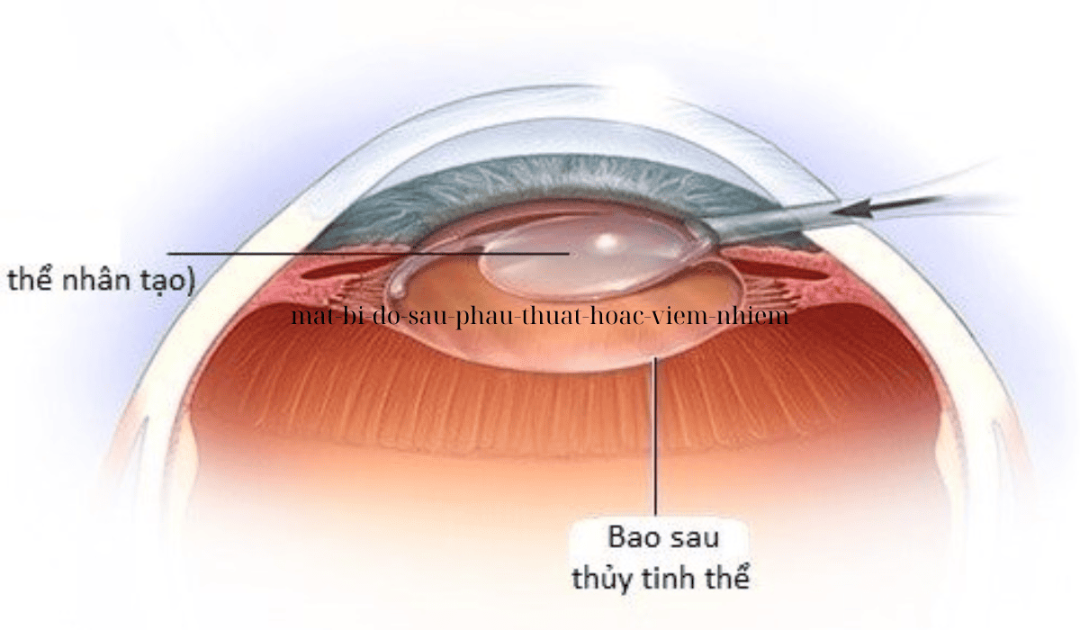 Minh họa cấu trúc thủy tinh thể mắt và vị trí đặt thể nhân tạo sau phẫu thuật đục thủy tinh thể.