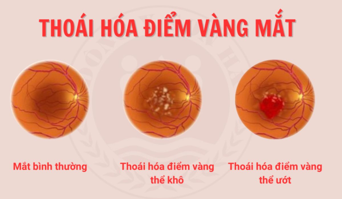 Mắt bình thường với thoái hóa điểm vàng thể ướt và thể khô – nguyên nhân gây mù lòa phổ biến ở người lớn tuổi