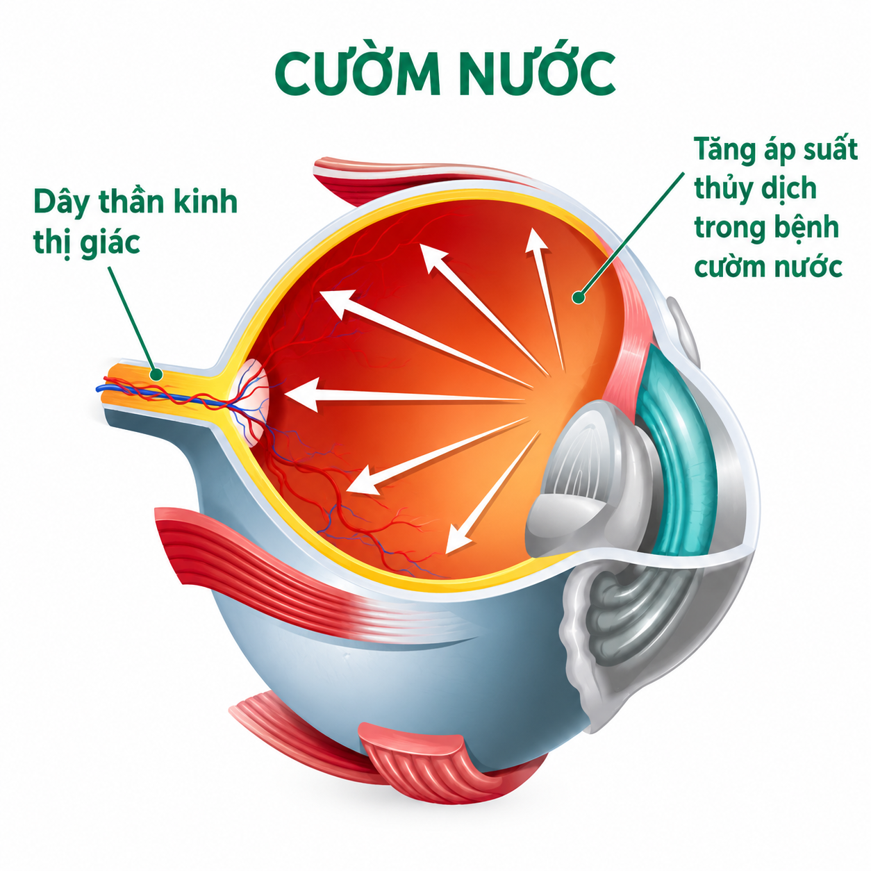 cườm nước nguy hiểm