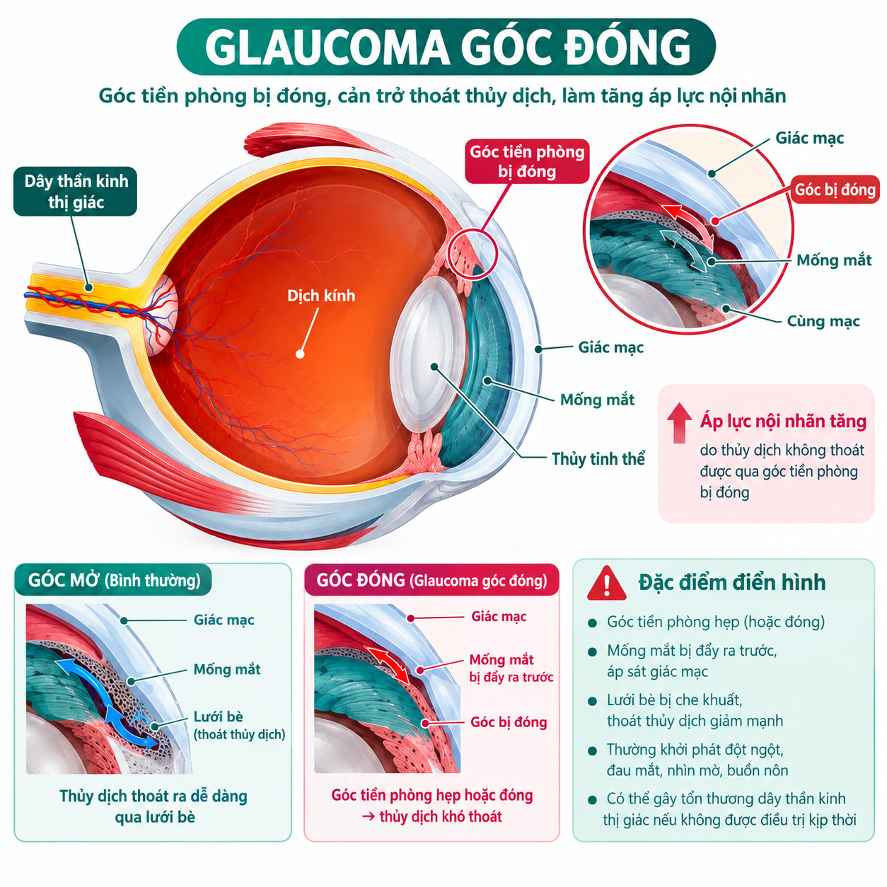 glaucoma góc đóng