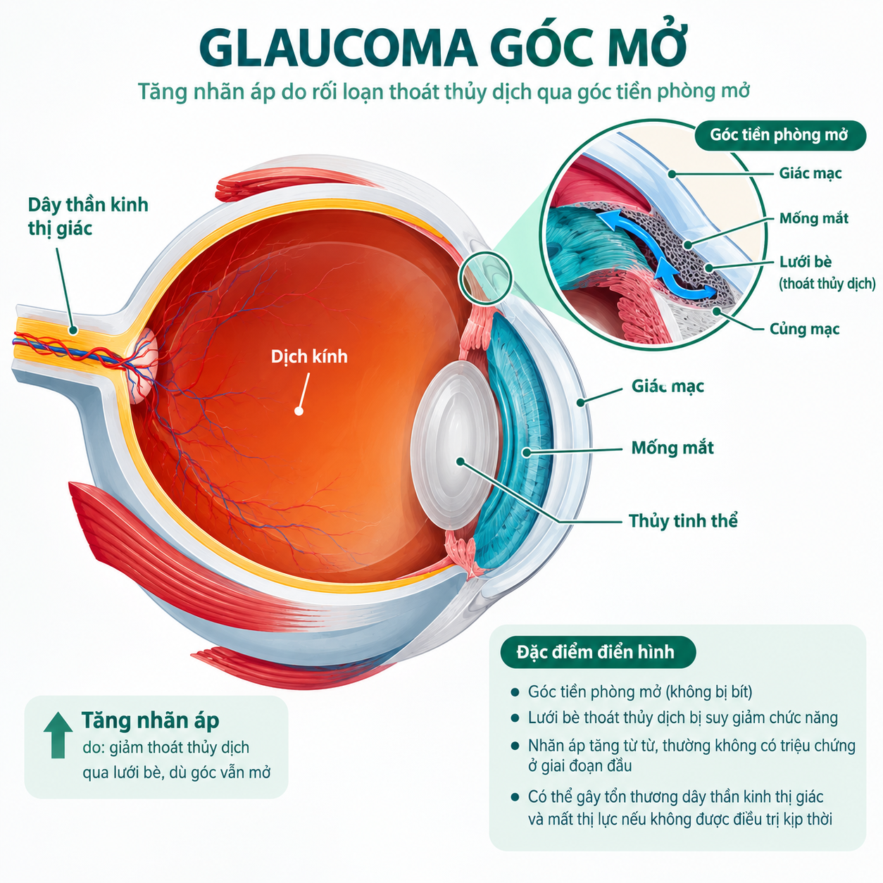 glaucoma góc mở