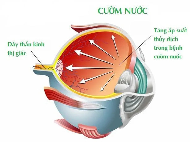 cườm nước là gì?