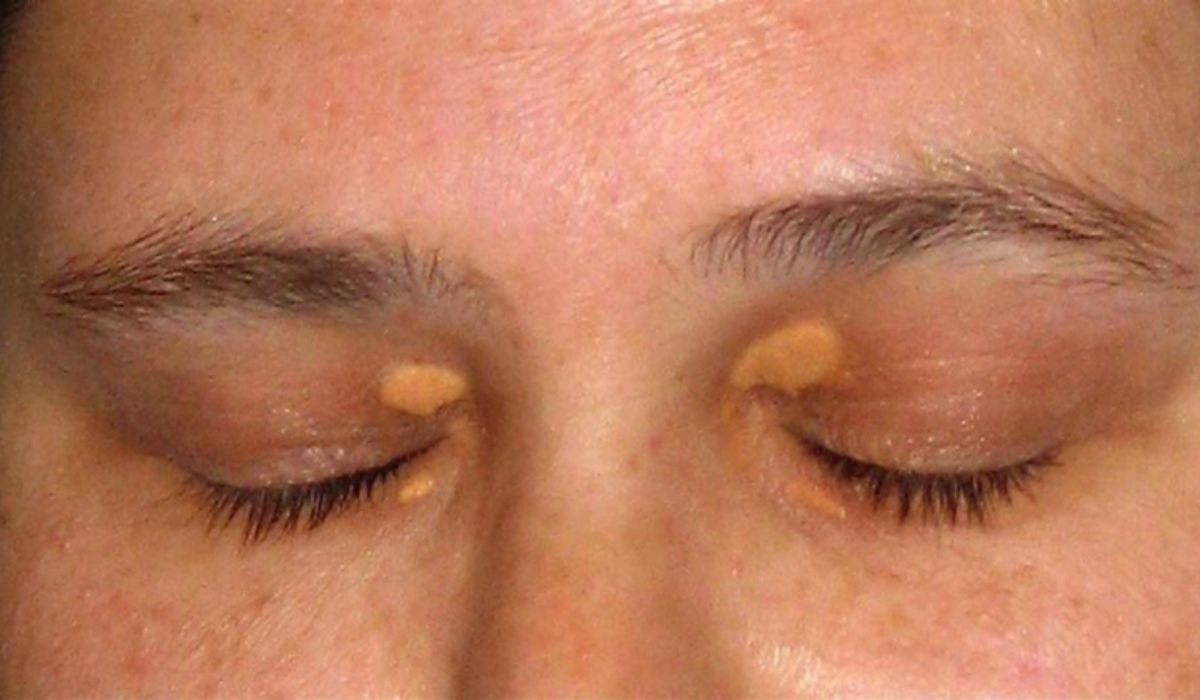 Các mảng u vàng đối xứng ở mi mắt trong – biểu hiện của rối loạn lipid máu