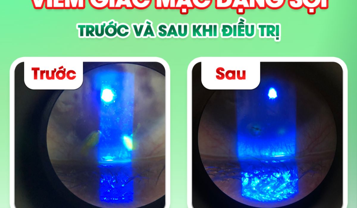Vêm giác mạc dạng sợi dưới đèn soi huỳnh quang, so sánh tình trạng trước và sau khi điều trị tại cơ sở nhãn khoa