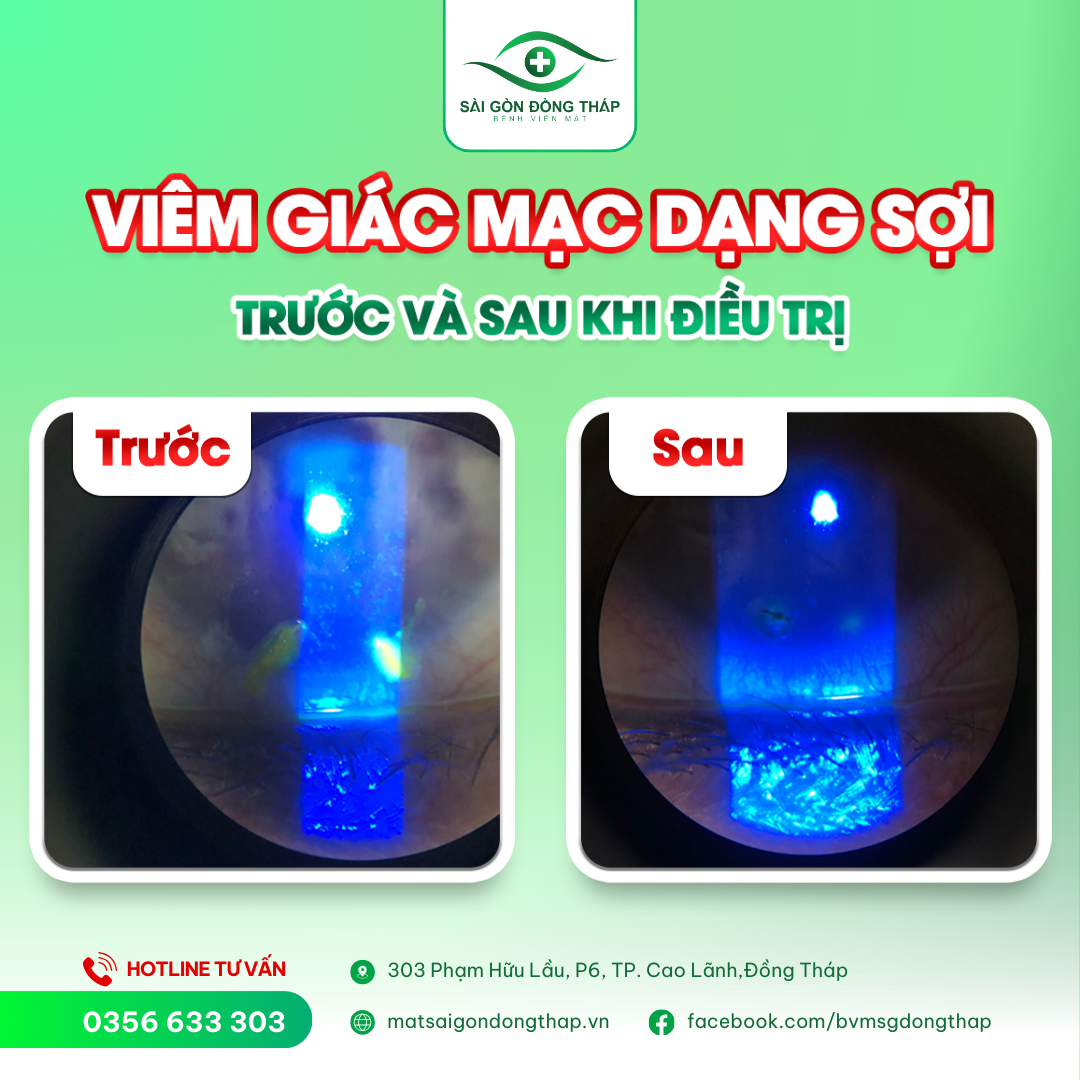 viêm giác mạc dạng sợi