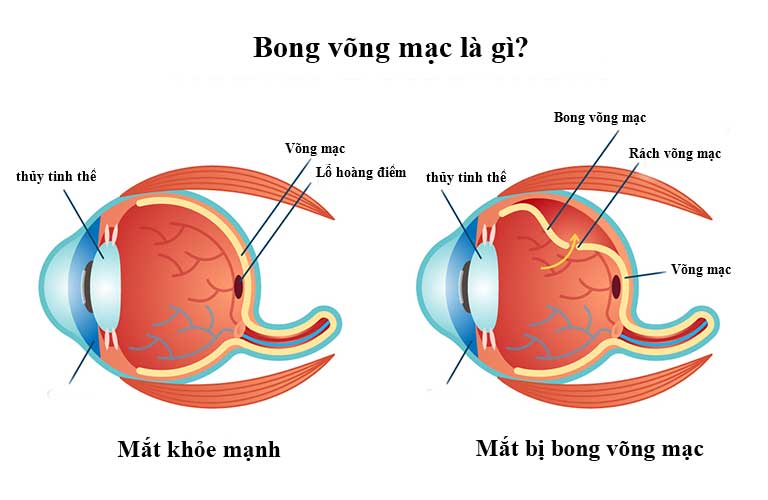 benh-bong-vong-mac-la-gi