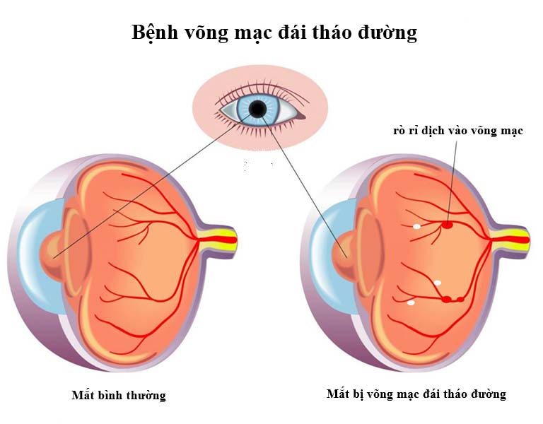 benh-vong-mac-dai-thao-duong-la-gi