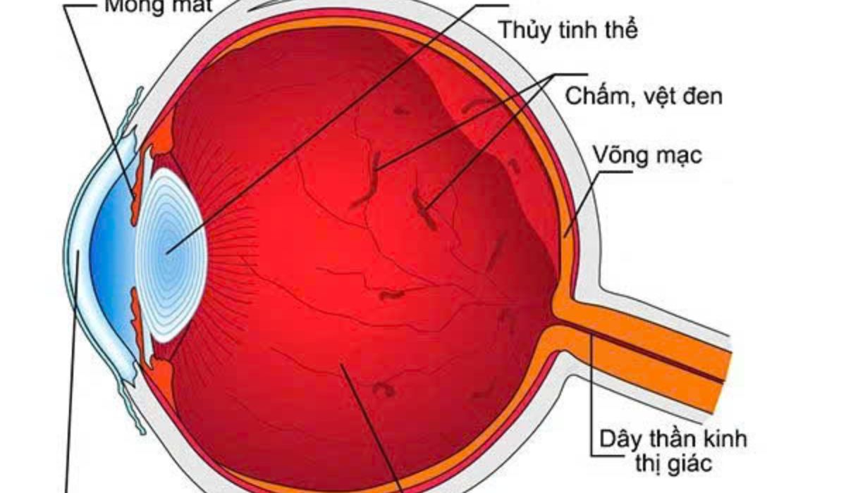 Hình ảnh minh họa cấu tạo mắt và dịch kính với các đốm vẩn đục bên trong