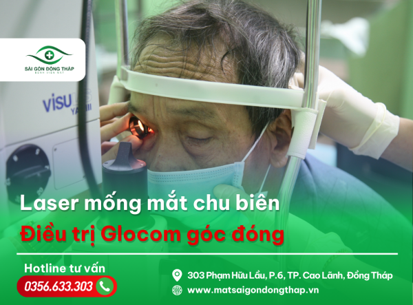 laser mống mắt chu biên