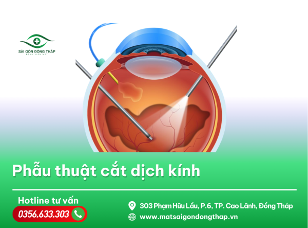 phẫu thuật dịch kính