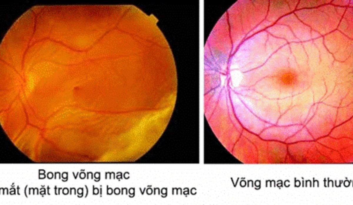Bên trái là võng mạc bị bong, bên phải là võng mạc bình thường, giúp nhận biết sự khác biệt bằng hình ảnh thực tế.