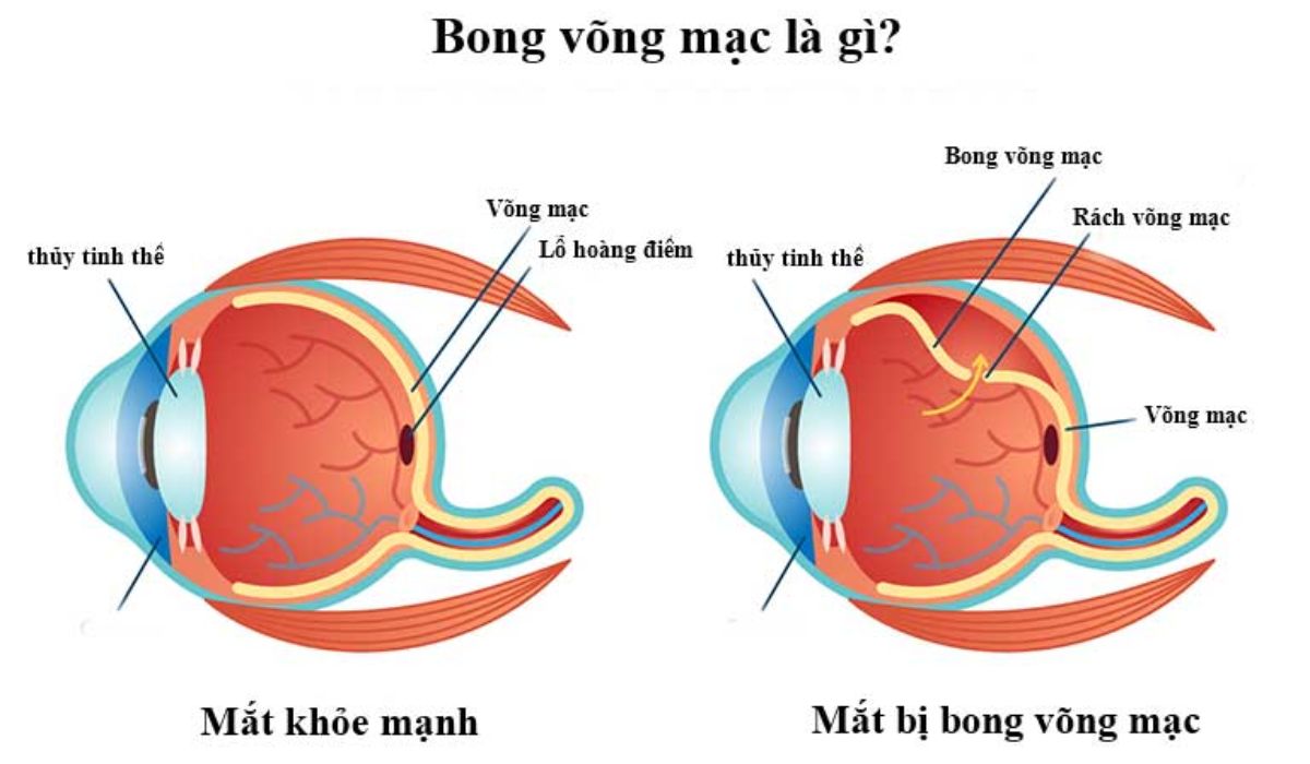 So sánh mắt khỏe mạnh và mắt bị bong võng mạc, cho thấy vị trí võng mạc, thủy tinh thể và vùng rách võng mạc.