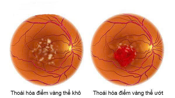 thoái hóa điểm vàng tuổi già