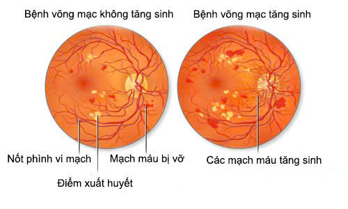 võng mạc tiểu đường