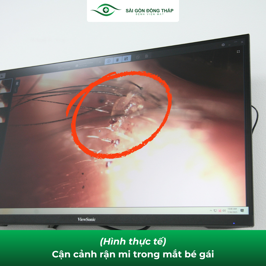 hình ảnh thực tế rận mi mắt