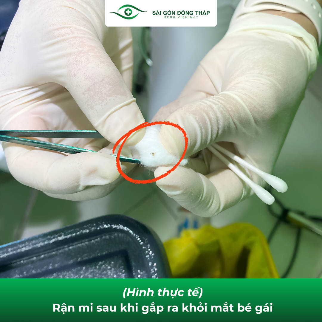 rận mi mắt tại nhà 