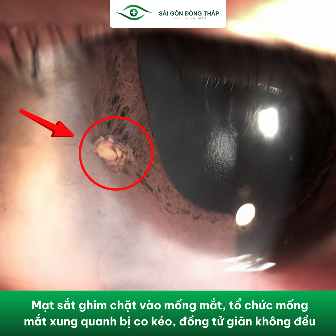 hình ảnh mạt sắt trong mắt 