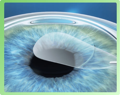 phẫu thuật clear