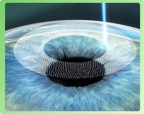 Phẫu thuật Femto Pro