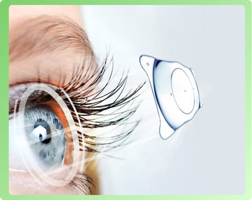 phẫu thuật phakic ipcl