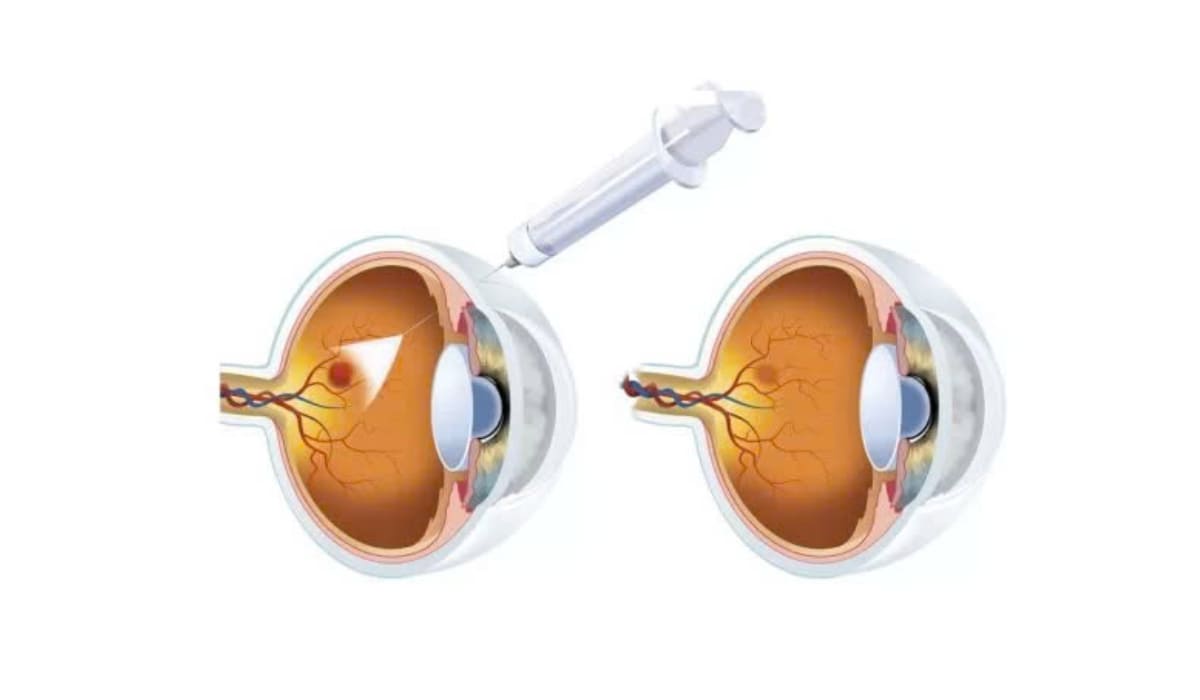 Quy trình vệ sinh và nhỏ thuốc tê chuẩn bị cho ca tiêm nội nhãn