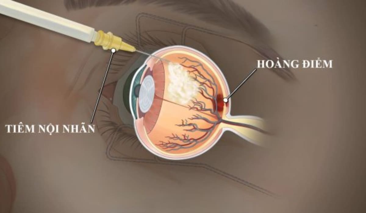 Sơ đồ thuốc Anti-VEGF ức chế sự phát triển của mạch máu bất thường dưới võng mạc