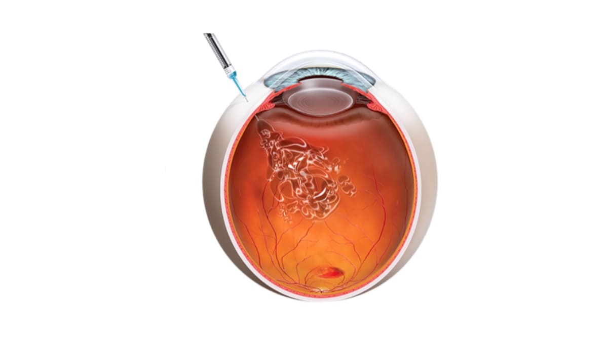 tiêm nội nhãn định kỳ