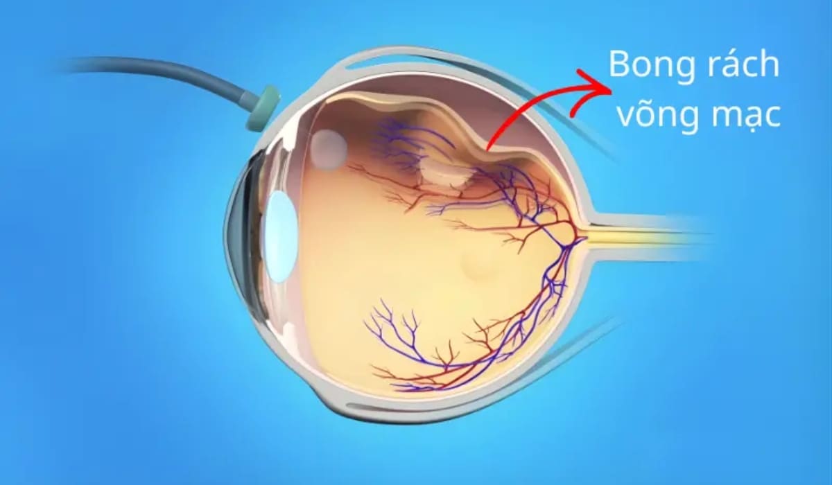 Nguyên nhân gây bệnh võng mạc và các yếu tố nguy cơ