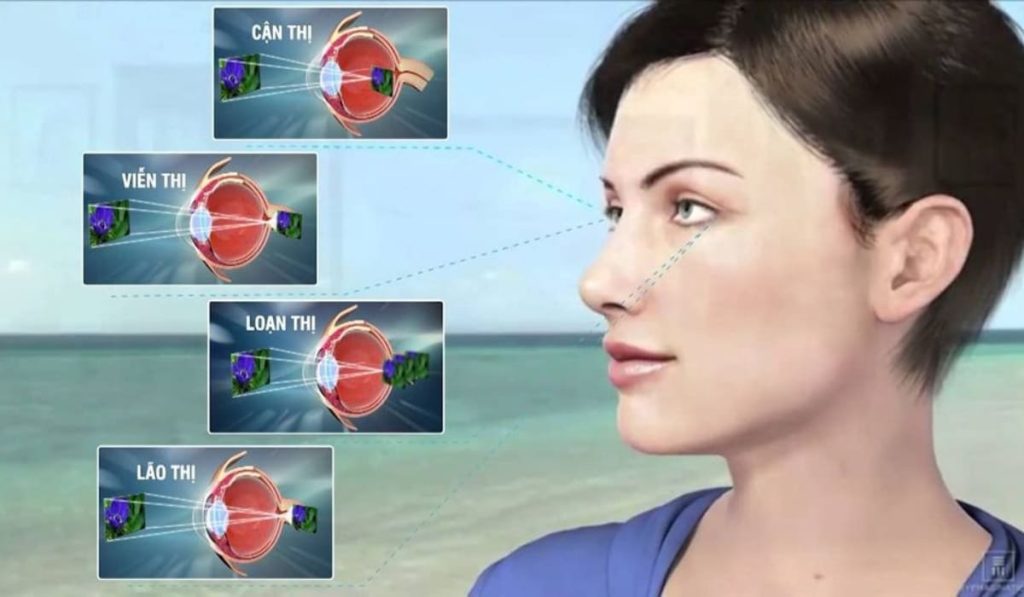 Phân biệt triệu chứng cận thị viễn thị loạn thị và lão thị.