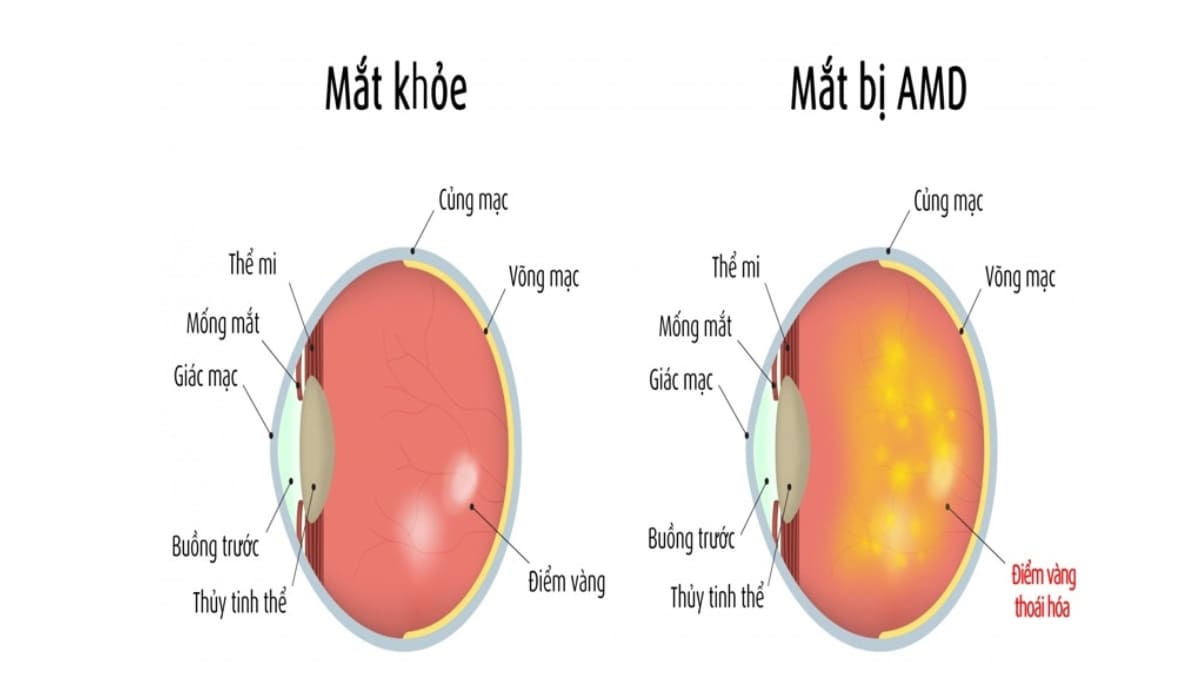 So sánh mắt bình thường và mắt bị thoái hóa điểm vàng AMD thể khô và thể ướt 