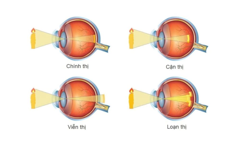 Tật khúc xạ là gì và cơ chế hội tụ ánh sáng tại võng mạc